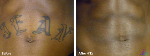 Before and after tattoo removal